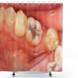 Personality  Dental Problems Shower Curtains