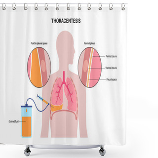 Personality  Thoracentesis Procedure Medical Poster. Obtain Fluid From Space Around The Compressed Lung. Incision Of The Chest Wall. Unhealthy Internal Organs, Respiratory System Disease Flat Vector Illustration Shower Curtains