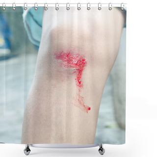 Personality  Bleeding Scraped Human Knee After Falling From Bike Shower Curtains