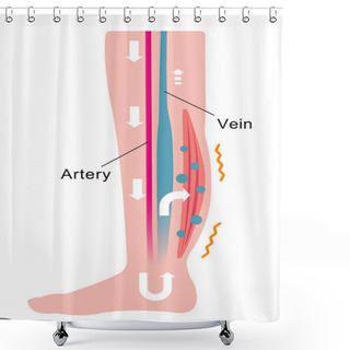 Personality  Cause Of Swelling(edema) Of The Legs. Water Leaks From The Veins And Swelling Occurs. Flat Illustration Shower Curtains