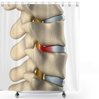 Personality  Spinal Cord Under Pressure Of Bulging Disc Shower Curtains