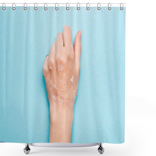 Personality  Cropped View Of Female Hand With Dry, Exfoliated Skin On Blue Shower Curtains