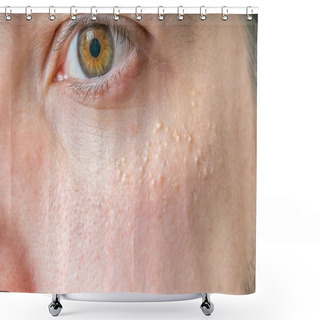 Personality  Milia (Milium) - Pimples Around Eye On Skin. Shower Curtains