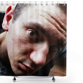 Personality  Acne Pimples On The Face Shower Curtains