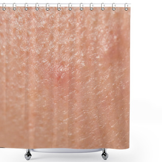 Personality  Pimples On The Skin. Close Shower Curtains