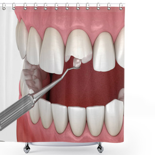 Personality  Restoration Of Broken Tooth. Medically Accurate 3D Illustration. Shower Curtains