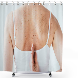 Personality  Cropped View Of Woman With Diseased Skin Isolated On White  Shower Curtains