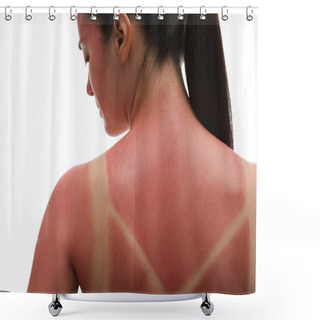 Personality  Woman With Sunburned Skin On White Background, Closeup Shower Curtains