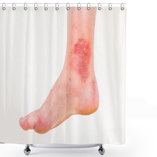 Personality  Red Rash On Leg Of Patient Who Was Bitten By An Insect Shower Curtains