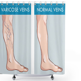 Personality  Illustration Of A Healthy Leg And The Affected Varicose Veins Shower Curtains