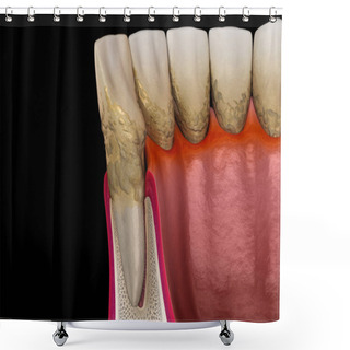 Personality  Periodontitis Stage 3, Gum Recession, Tartar. Medically Accurate 3D Illustration Shower Curtains
