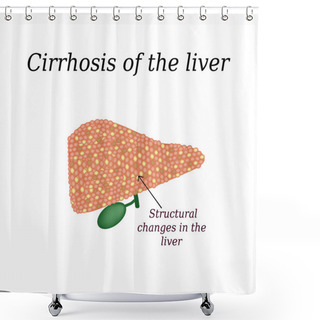 Personality  Cirrhosis Of The Liver. Vector Illustration On Isolated Background Shower Curtains
