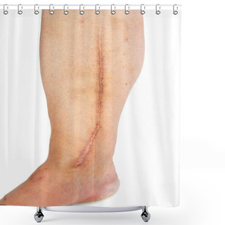 Personality  Human Leg With Postoperative Scar Of Cardiac Surgery Shower Curtains