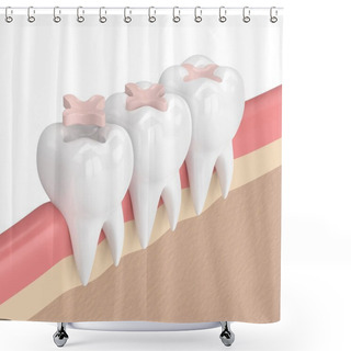 Personality  3d Render Of Teeth With Dental Inlay Filling Shower Curtains