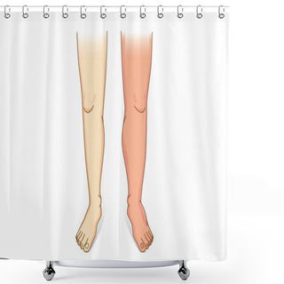 Personality  Human Leg Swelling In Front View. Illustration About The Diseases And Conditions Of Fluid Gathers In Foot And Leg. Shower Curtains