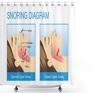 Personality  Anatomy Of Human Airway While Snoring Shower Curtains