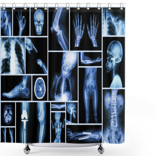 Personality  Collection X-ray Multiple Part Of Human & Orthopedic Surgery & Multiple Disease (Osteoarthritis Knee,spondylosis,Stroke,Fracture Bone,Pulmonary Tuberculosis, Etc) Shower Curtains