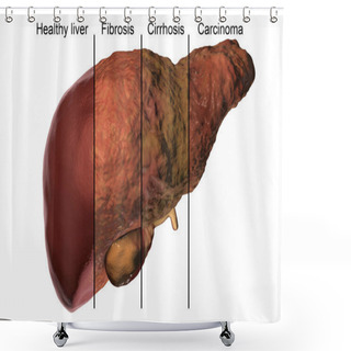 Personality  Liver Disease Progression In Hepatitis B And C Virus Infection Shower Curtains