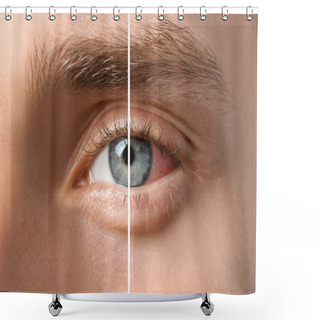Personality  Young Man Without And With Eye Redness, Closeup Shower Curtains