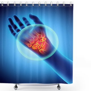 Personality  Wrist Painful - Skeleton X-ray. Shower Curtains