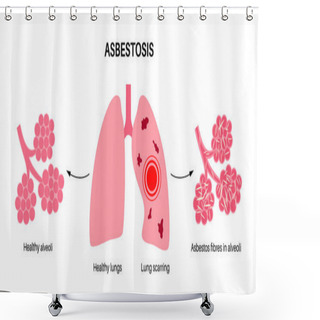 Personality  Asbestosis Anatomical Poster. Lung Disease Concept, Asbestos Fibers. Lung Tissue Scarring And Shortness Of Breath, Pain In Chest. Breathing Problem, Illness Of Respiratory System Vector Illustration. Shower Curtains