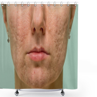 Personality  Problematic Skin Shower Curtains