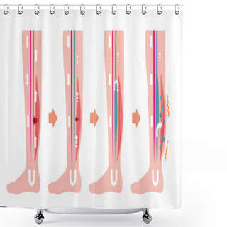 Personality  Cause Of Swelling (edema) Of The Legs. Flat Illustration Shower Curtains