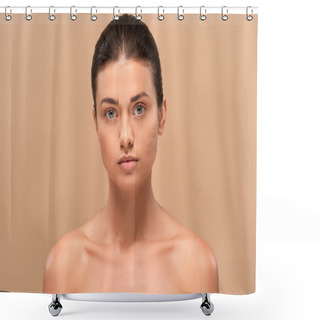 Personality  Young Naked Woman With Problem Skin Looking At Camera Isolated On Beige  Shower Curtains