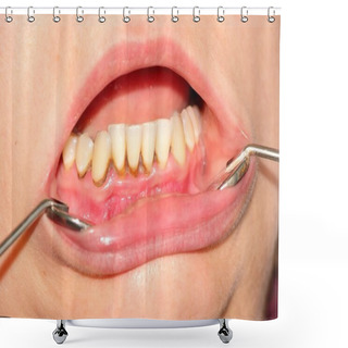 Personality  Tartar And Dental Plaque Shower Curtains