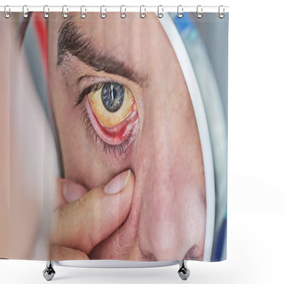 Personality  Human Eye With Yellow Eyeball, Closeup. Yellow Eyes Is A Symptom Of Liver Disease Or Hepatitis Shower Curtains