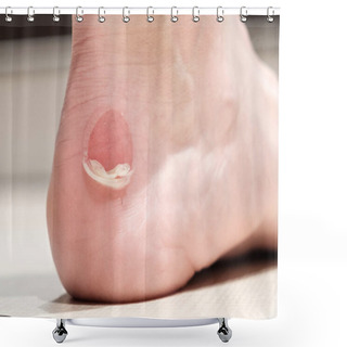 Personality  Big Bloody Callus On Man's Heel Shower Curtains