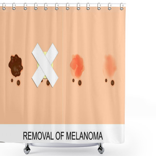 Personality  Removal Of Melanoma Shower Curtains