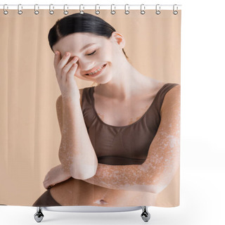 Personality  Smiling Young Beautiful Woman With Vitiligo Posing In Underwear Isolated On Beige Shower Curtains