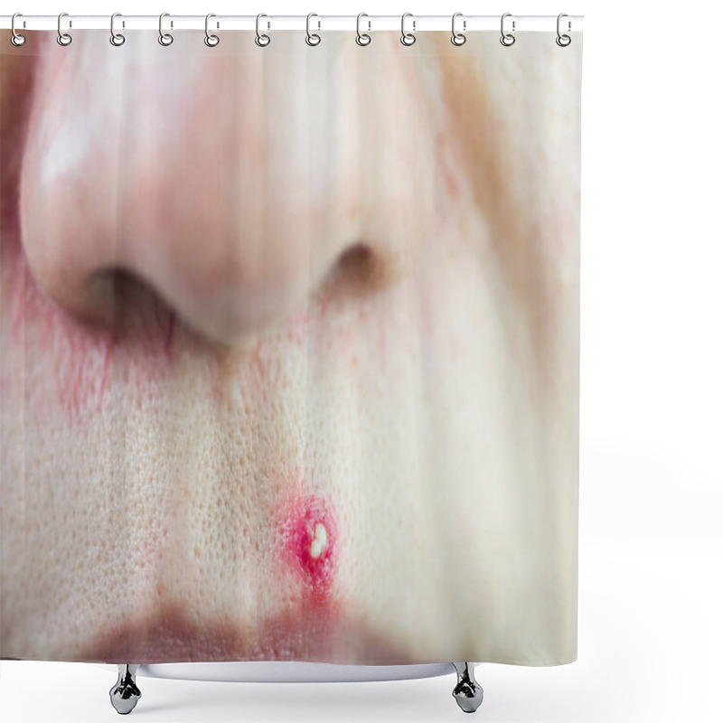 Personality  The Infected Pustulous Acne On Face, Selective Focus On Acne Shower Curtains