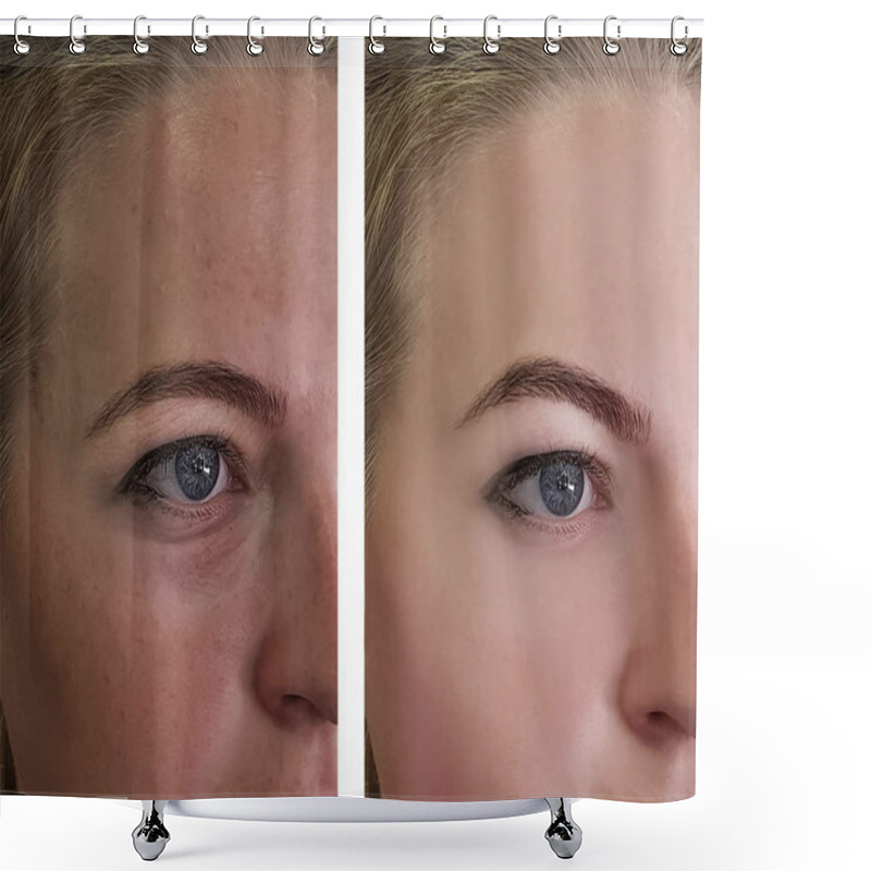 Personality  Girl Wrinkles Eyes Before And After Treatments Shower Curtains