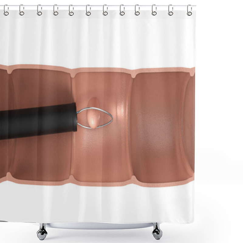 Personality  Endoscope Remove Colonic Polyp  Shower Curtains