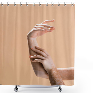 Personality  Cropped View Of Female Hands With Vitiligo Isolated On Beige Shower Curtains
