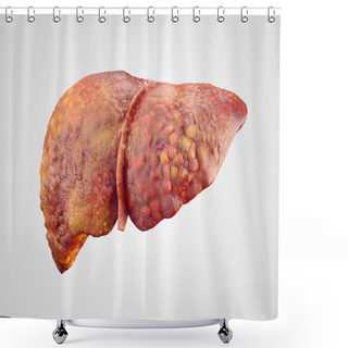 Personality  Realistic Illustration Of Cirrhosis Of Human Liver Shower Curtains