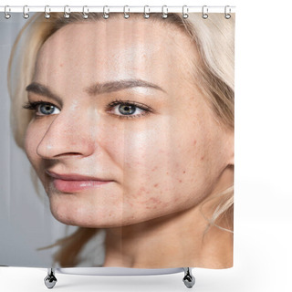 Personality  Close Up View Of Woman With Acne On Skin Looking Away Isolated On Grey  Shower Curtains