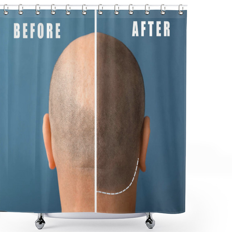 Personality  Man before and after hair loss treatment on color background shower curtains