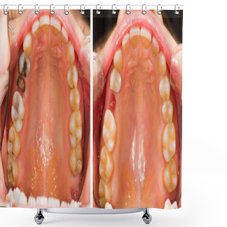 Personality  Before And After Dental Treatment Shower Curtains