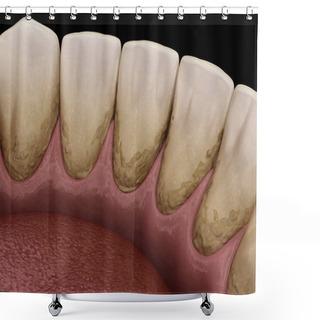 Personality  Tartar And Bactrail Tooth Plaque, Lower Jaw. Medically Accurate 3D Illustration Of Human Teeth Treatment Shower Curtains