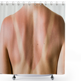 Personality  Close-up Of A Sunburn Marks On A Woman's Back Shower Curtains