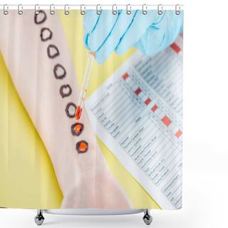 Personality  Cropped View Of Doctor Examining Allergic Reaction Near Allergy Test Results On Yellow Shower Curtains