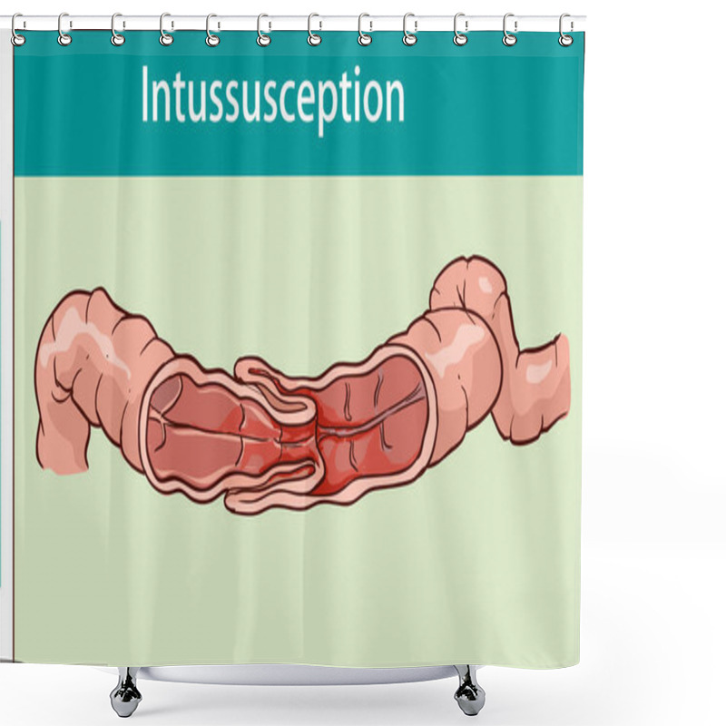 Personality  Vector Illustration Of Intussusception Of Intestine. Obstruction Shower Curtains
