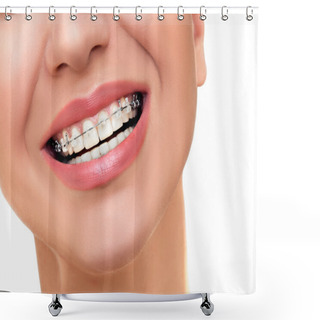 Personality  Orthodontic Treatment. Dental Brackets. Shower Curtains