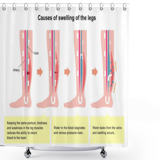 Personality  Cause Of Swelling (edema) Of The Legs. Flat Illustration Shower Curtains