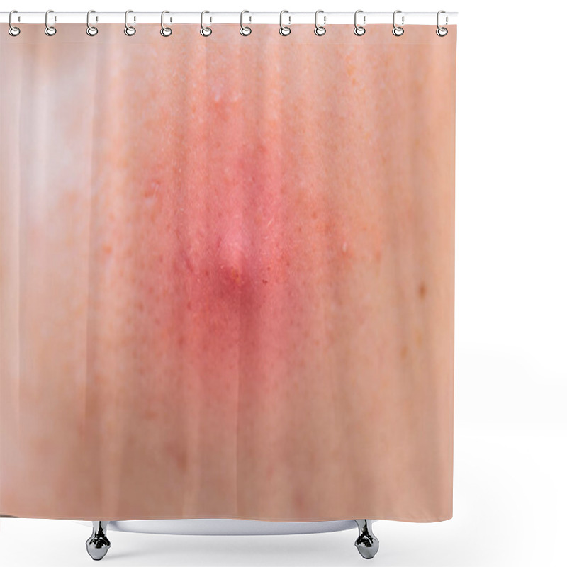 Personality  Closeup Big Acne Head Skin Inflammation Problem Shower Curtains