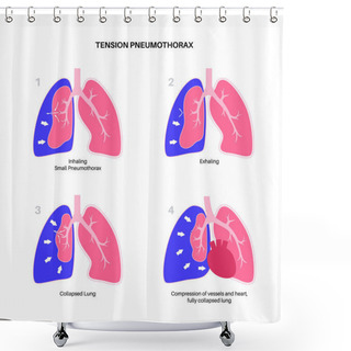 Personality  Tension Pneumothorax Disease. Reducing The Amount Of Blood Returned To The Heart. Lung Or Chest Wall Injury. Chest Pain, Shortness Of Breathing. Unhealthy Internal Organs In Respiratory System Vector Shower Curtains