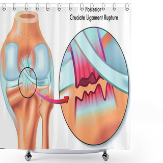 Personality  Medical Illustration Of Posterior Cruciate Ligament Ruptur Shower Curtains